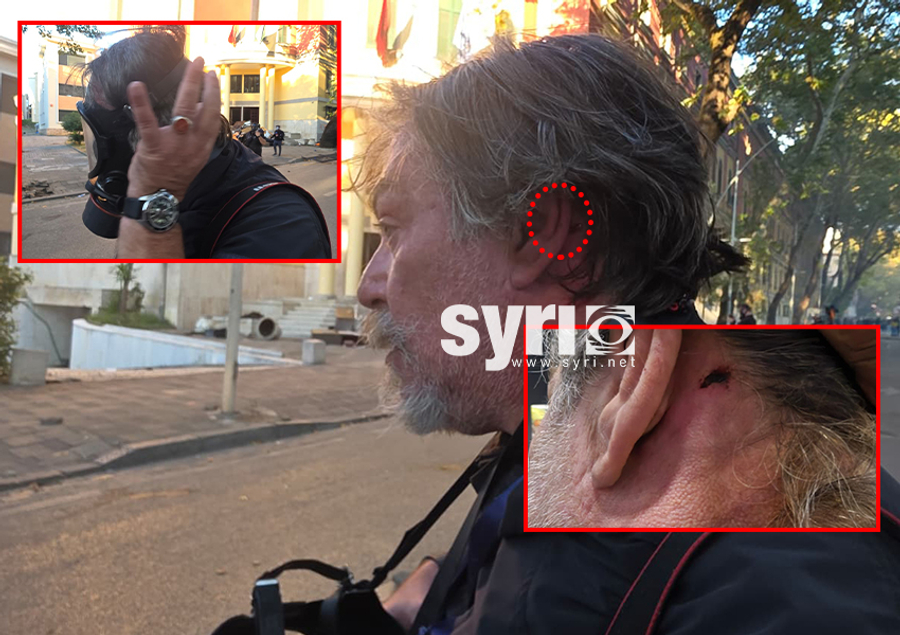 FOTO  Gjakoset nga narkopolicia e Ramës  fotoreporteri i SYRI t  Felix Bilani