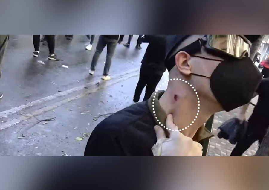 E rëndë/ Narkopolicia e Ramës godet me plumb gome studentin me leuçemi që tha në Syri TV: Nuk e di sa jetë kam...