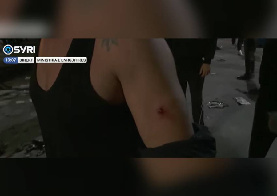  Na kanë bërë copa copa   Policia e Ramës godet me plumb gome në krah të riun protestues