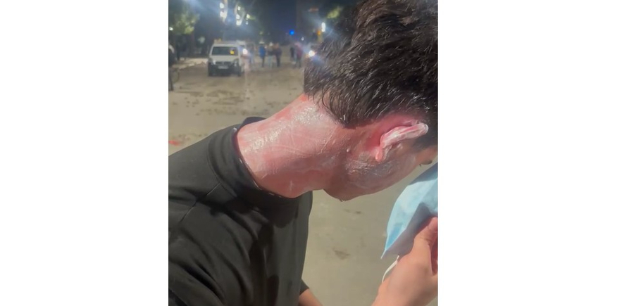 Policët masakrojnë me spraj adoleshentin  Shikoni pamjet