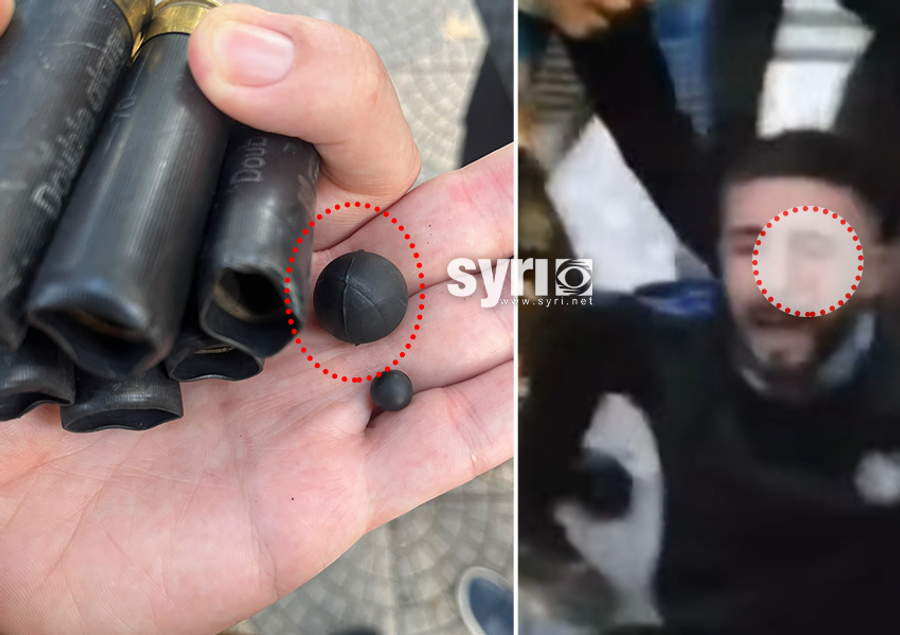 Dhuna barbare në protestë  U godit nga policia me plumb gome  i riu humb shikimin në syrin e majtë