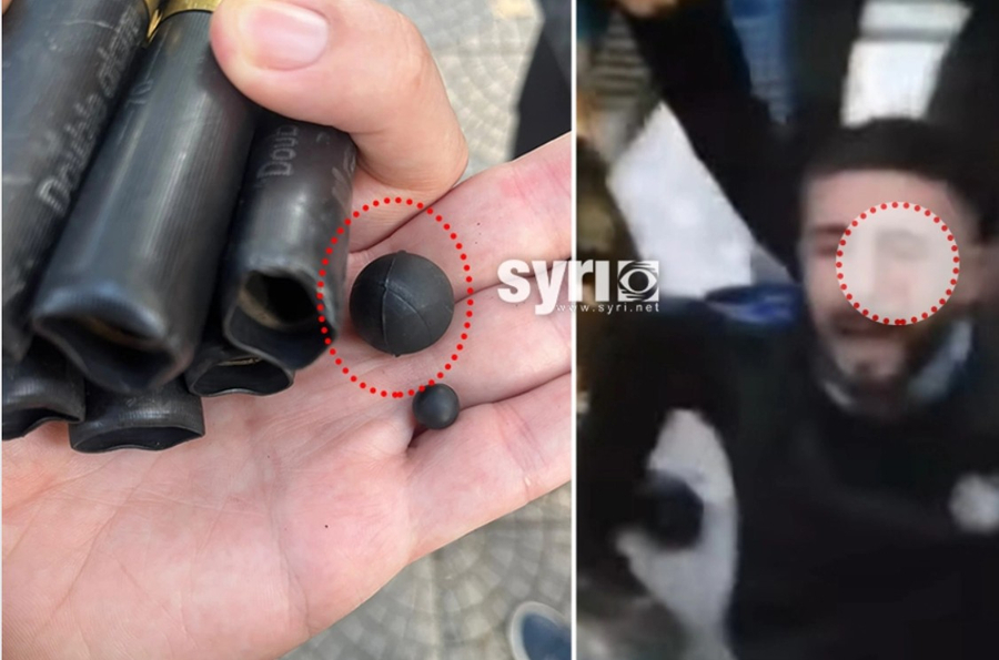 Policia dhunë çnjerëzore ndaj qytetarëve  plumb gome në sy të riut  nuk kursen as pedagogët  Dhjetra të plagosur