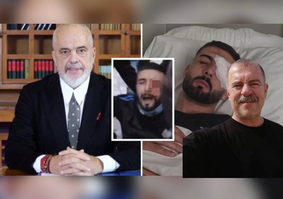 Rama tha se e nisi në avion të riun që humbi syrin nga salla VIP  Eksperti  Pacienti nuk është oligark  ja procedurat