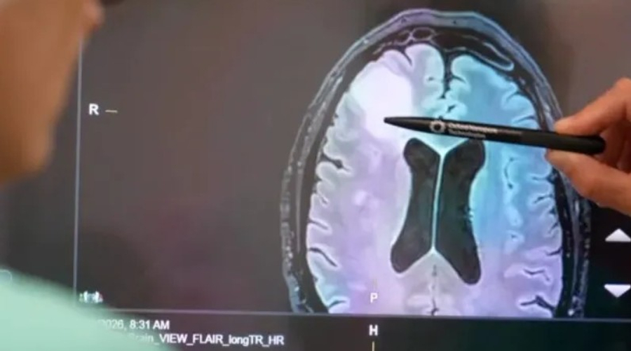 Nga javë në orë   teknologjia e re që përshpejton diagnostikimin e tumoreve të trurit
