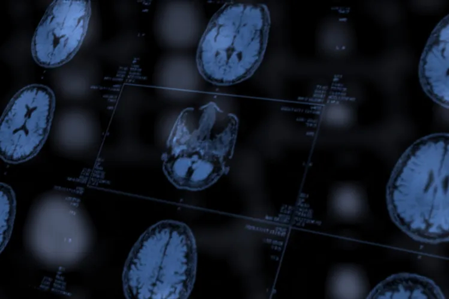 mri-mund-te-zbuloje-shenja-te-alzheimerit-me-heret
